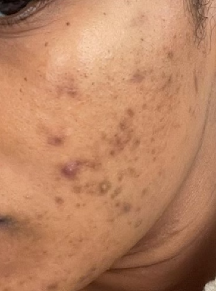 Got Dark Spots? Get To Know Tyrosinase Inhibition